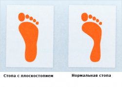 Как лечить плоскостопие у детей?